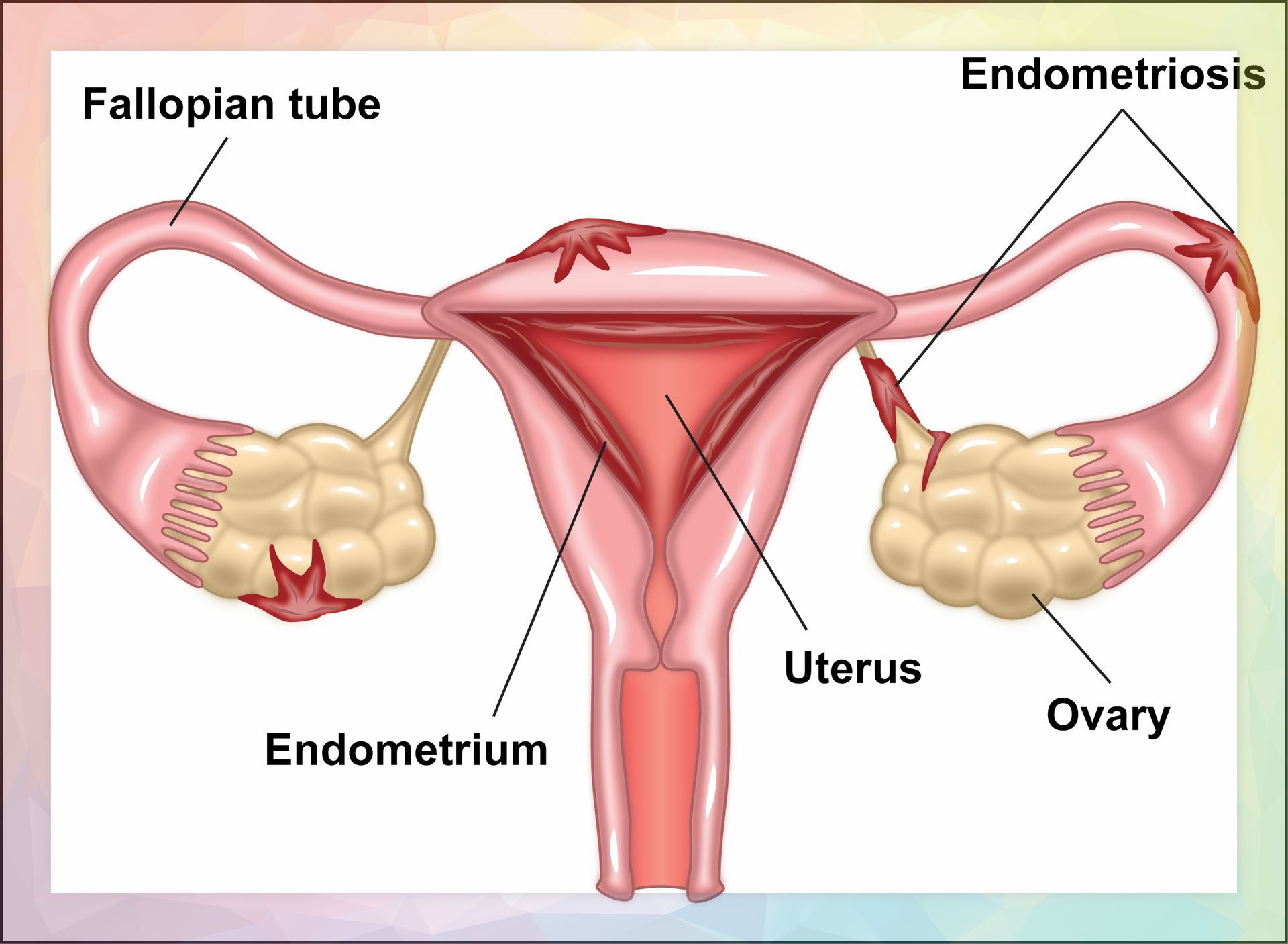 Endometrisis help Acupuncture relief for endometriosis