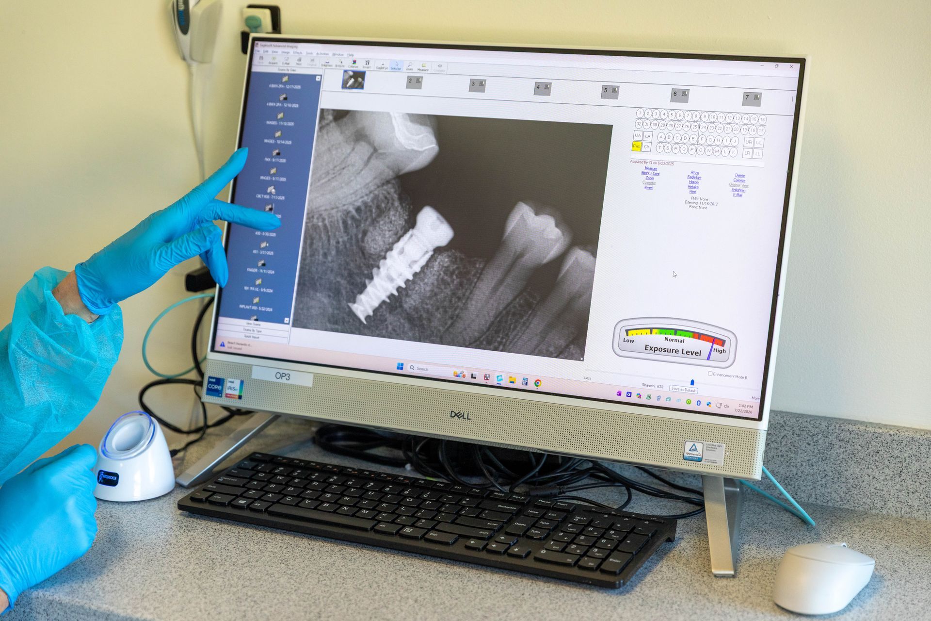 Gloved clinician pointing at dental X-ray on a computer monitor beside a keyboard and mouse