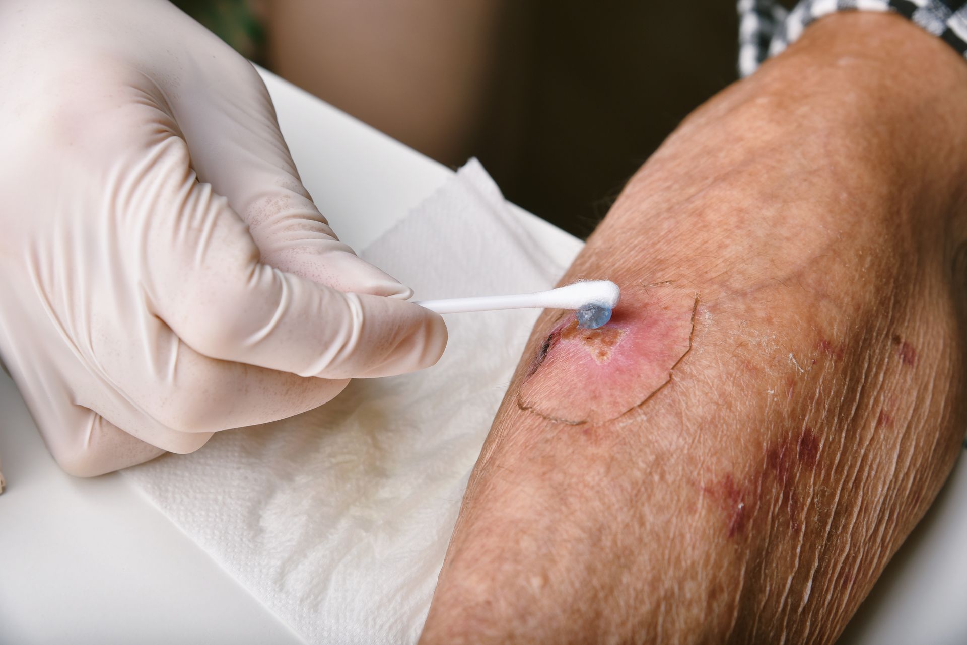 A gloved hand cleans a reddened wound on a person's arm with a cotton swab.