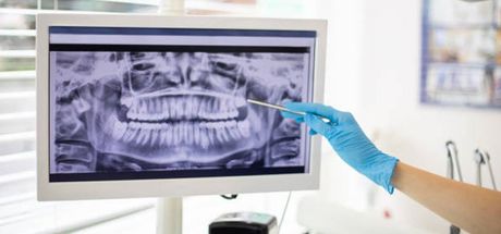 In un ambulatorio, una mano guantata indica una radiografia dentale panoramica visualizzata sullo schermo di un computer.
