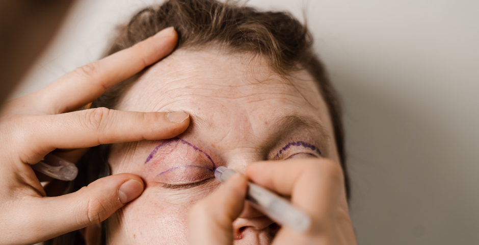blepharoplastie