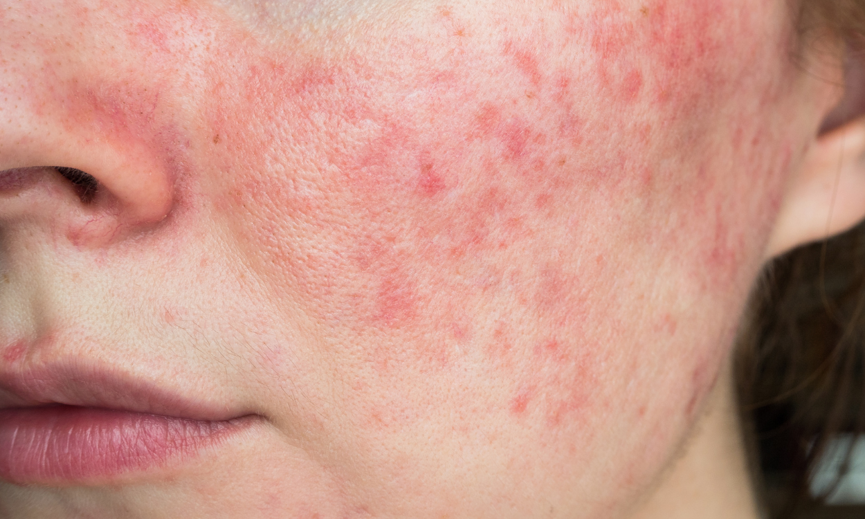 IPL et acné : agir sur l’inflammation et les bactéries