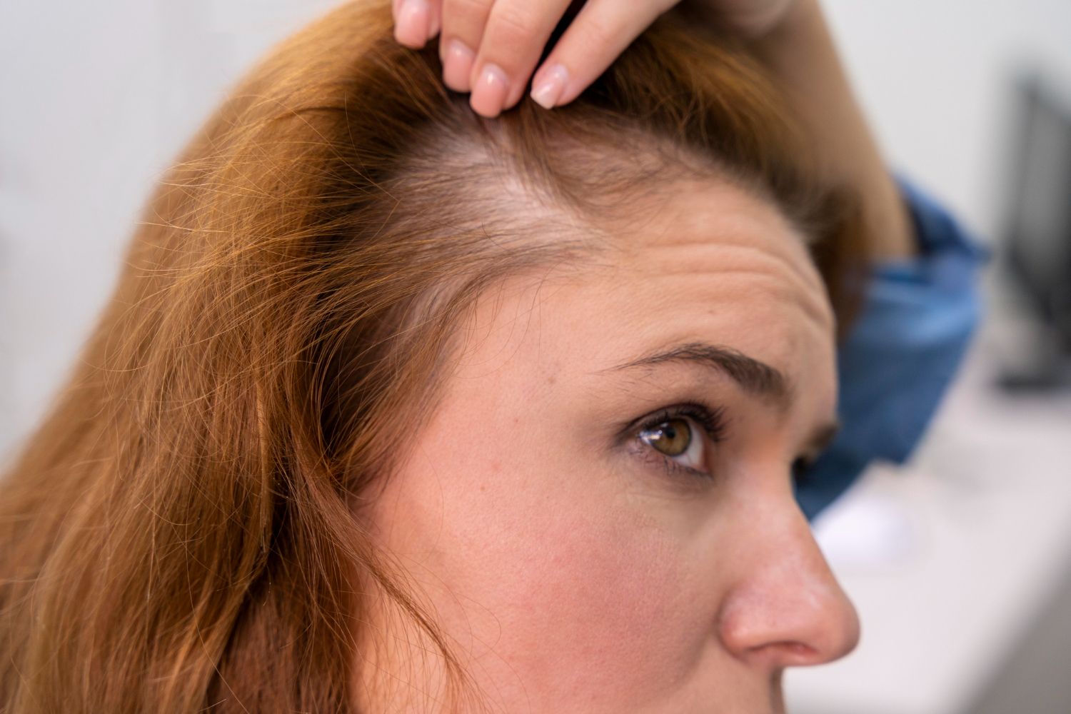 alopecie femme dr philippe yaeche