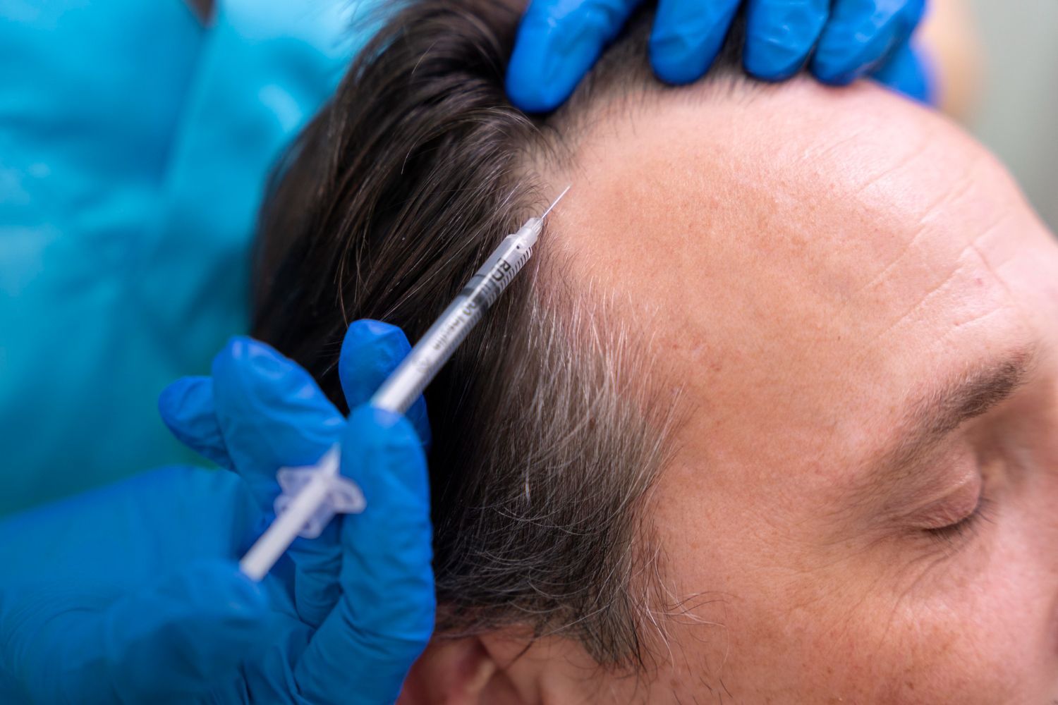 Mésothérapie capillaire : une solution pour ralentir la chute des cheveux ?