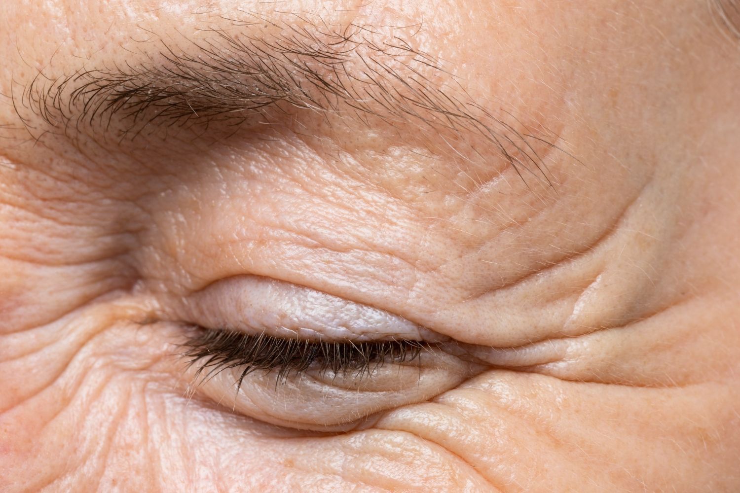 Paupières tombantes, rides, regard fatigué : découvrez les solutions de blépharoplastie sans chirurg