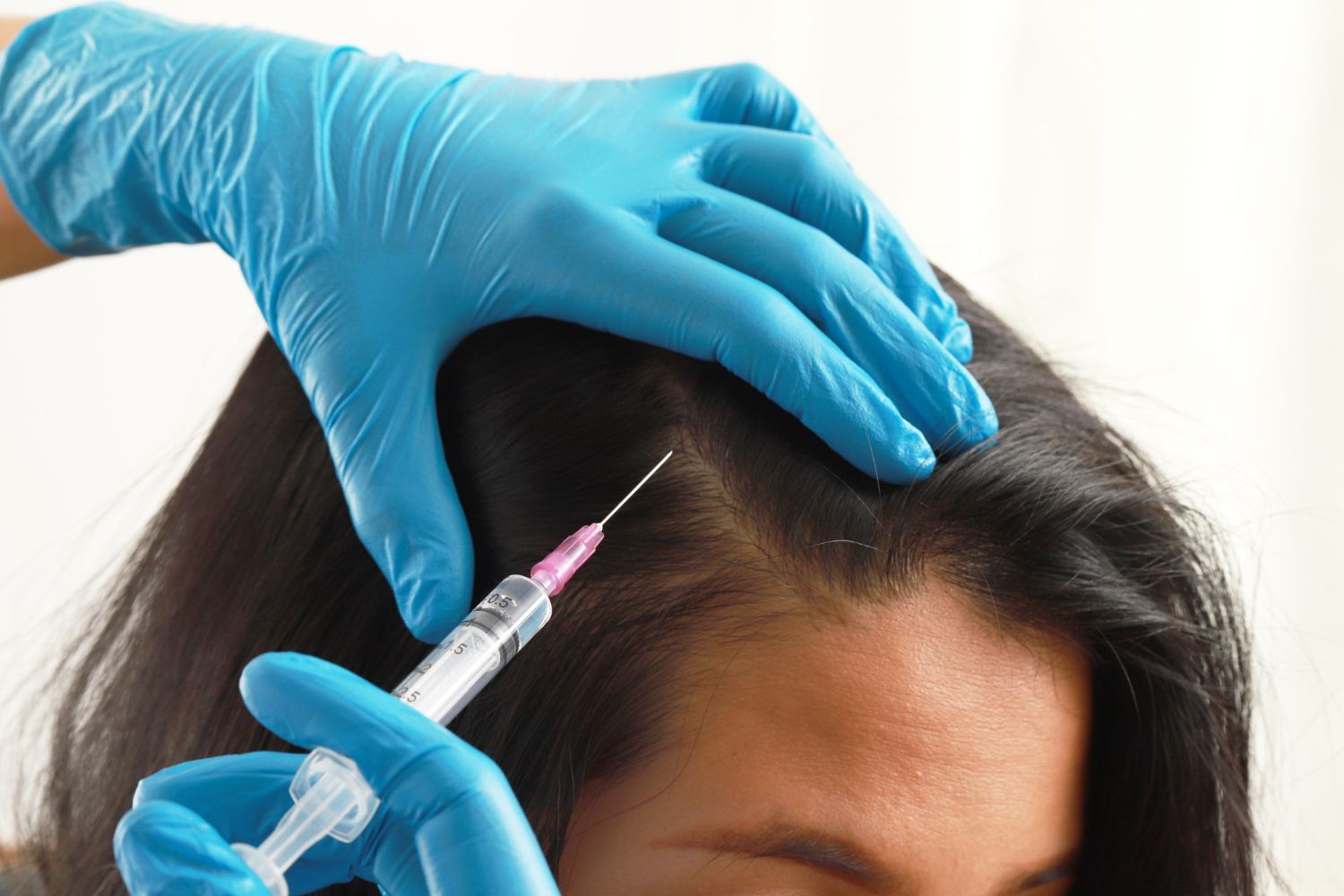 chute cheveux philippe yaeche Rouen medecin esthetique