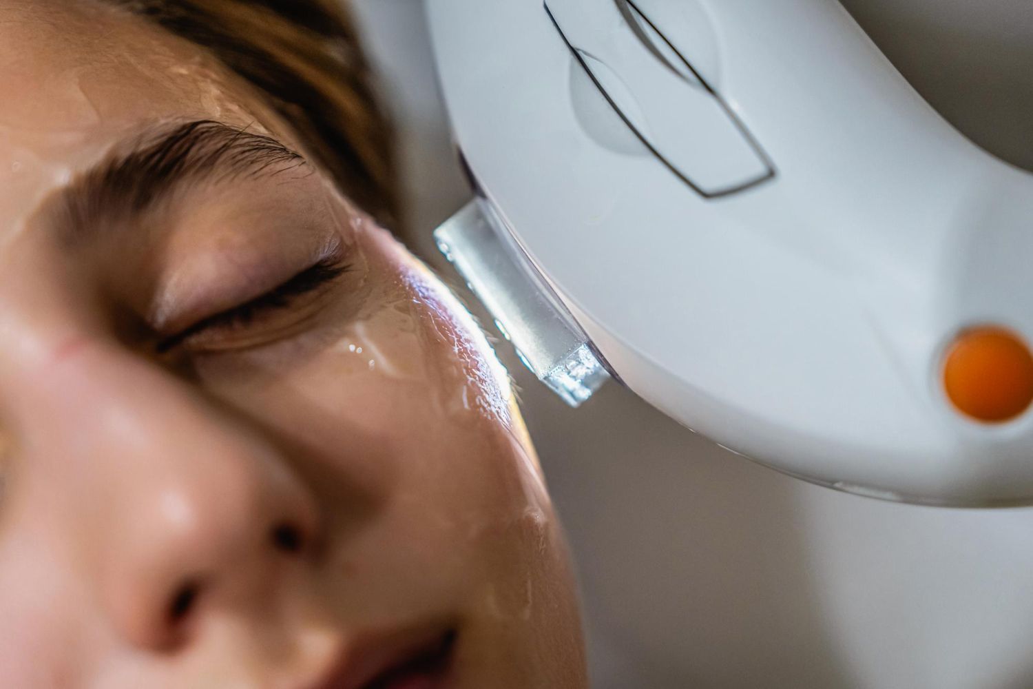Taches brunes, couperose, rougeurs ? Découvrez le traitement IPL-Sq® Vydence à Rouen avec le Dr Phil