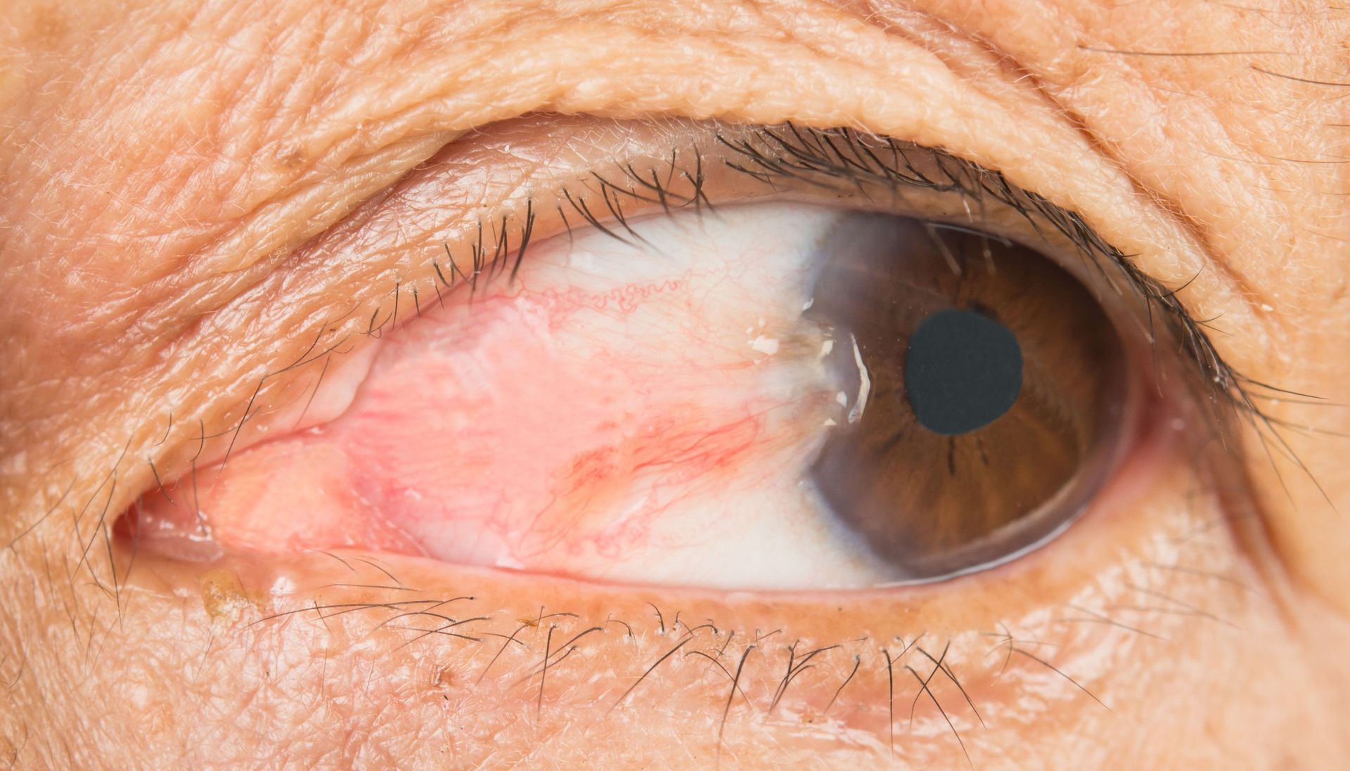 Brisbane Eye Surgeon Cataract