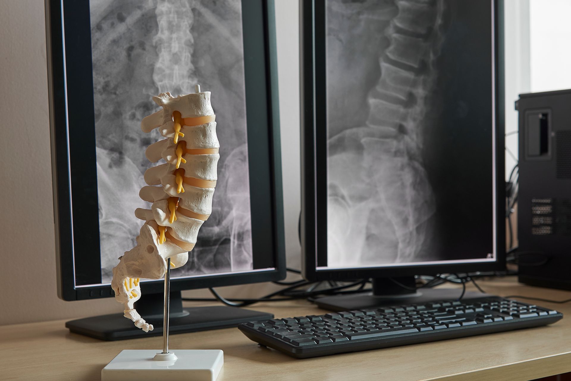 Spine model on a desk in front of two back X-ray scans and a keyboard