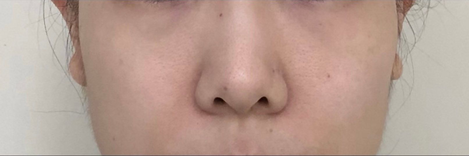 After photo showing improved facial skin texture following PRP microneedling treatment
