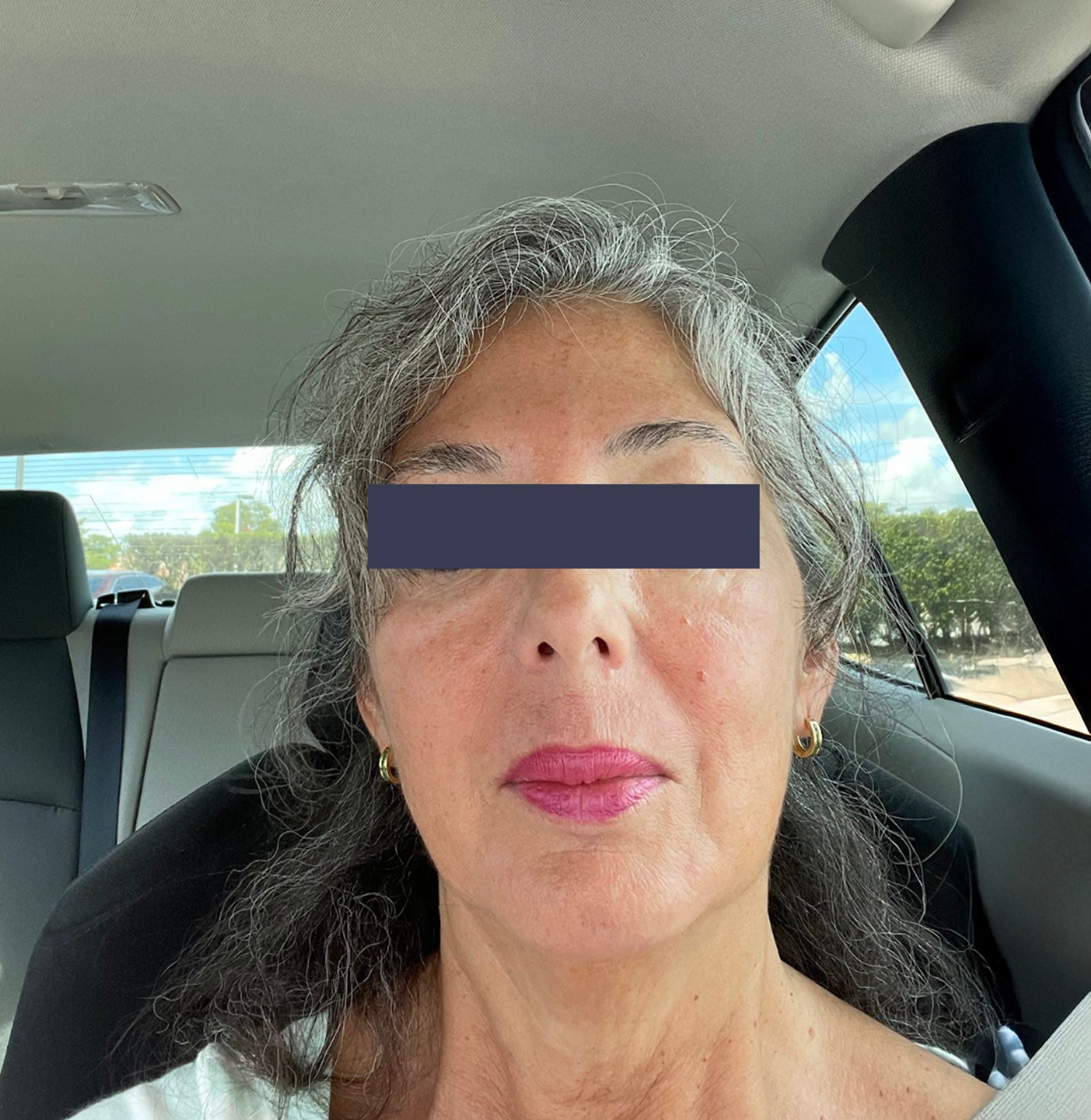 After photo showing improved facial contour following thread lift treatment