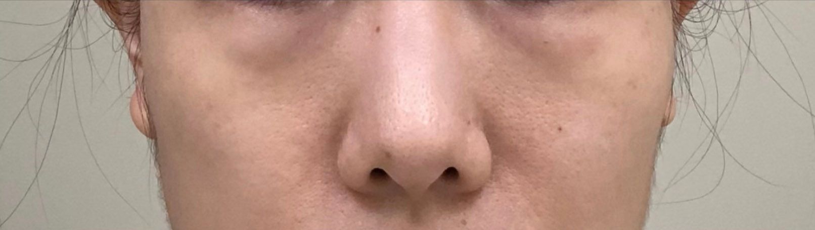 Before photo showing facial skin texture prior to PRP microneedling treatment