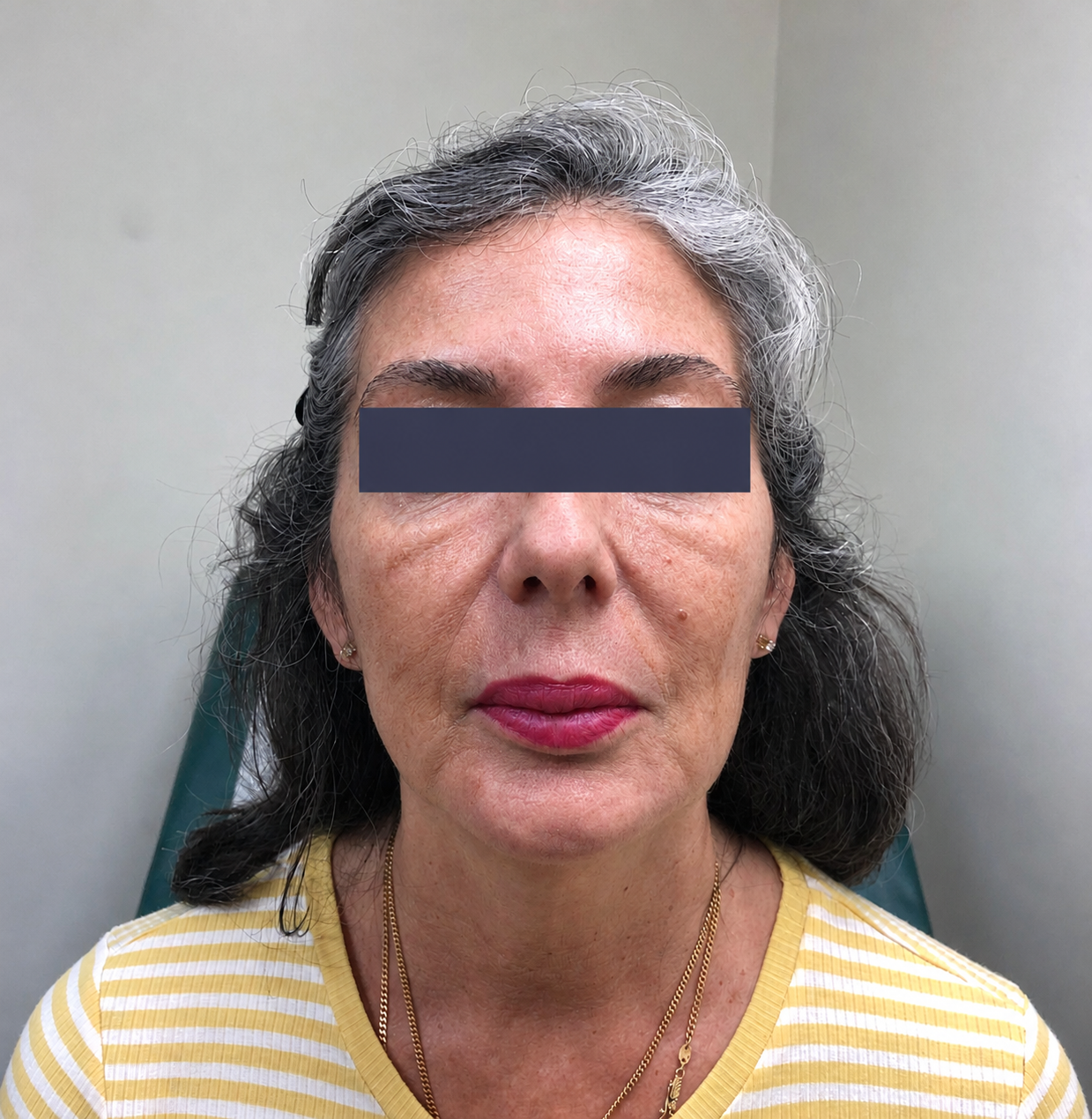 Before photo showing facial contours prior to thread lift treatment