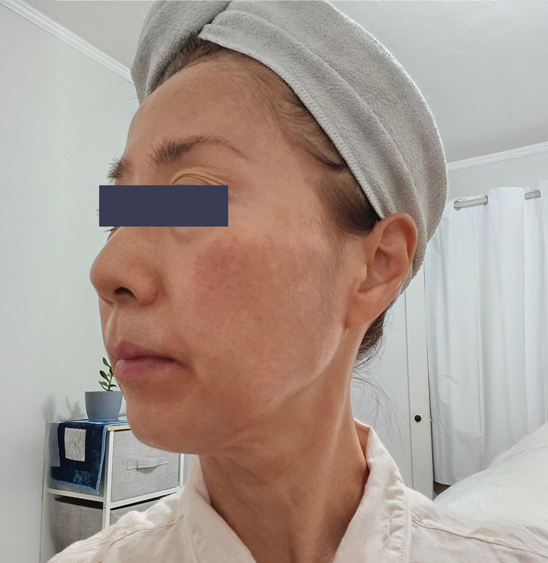 After photo showing smoother facial skin following Oligio skin tightening treatment
