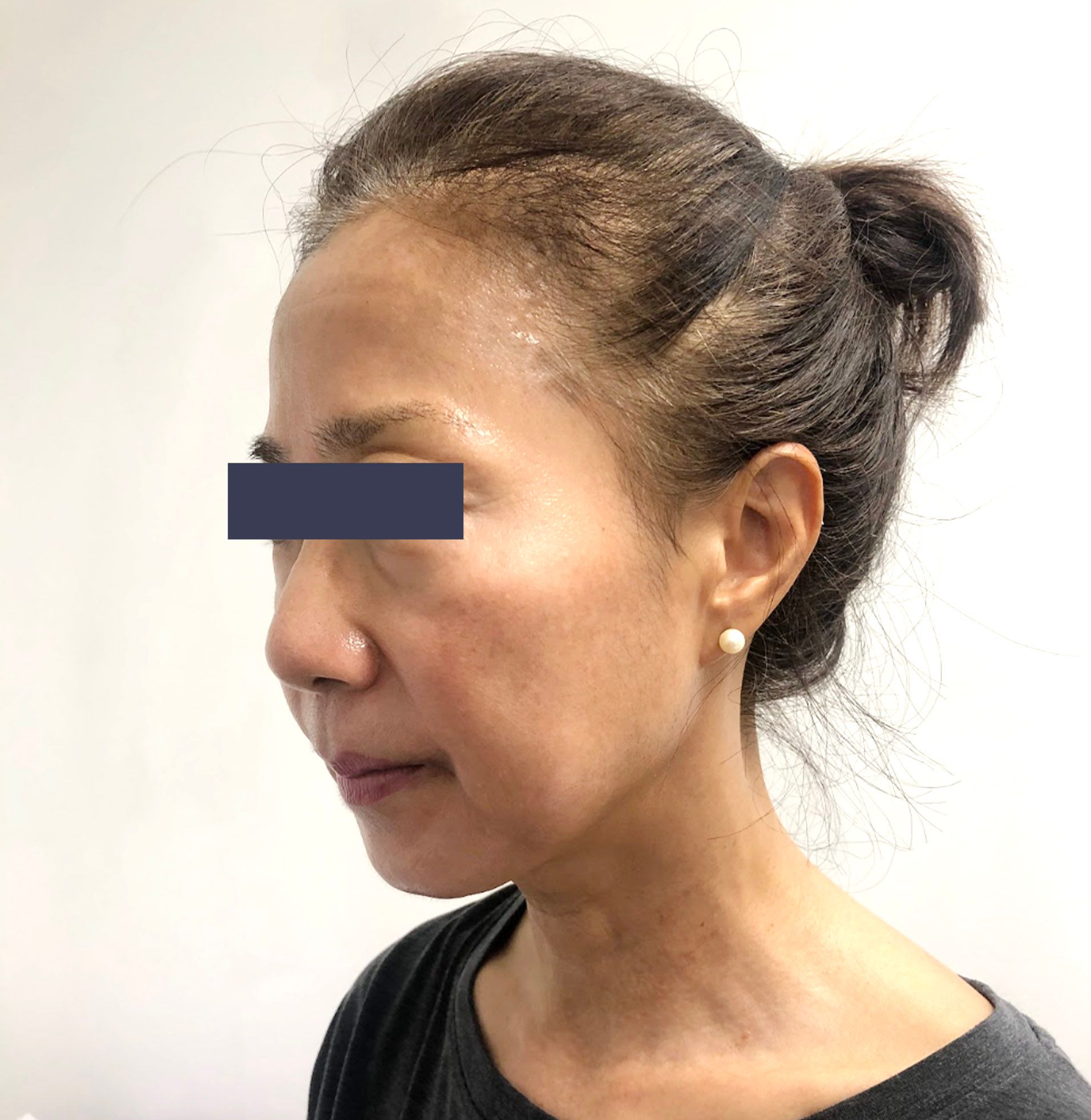 Before photo showing facial skin texture prior to Oligio skin tightening treatment