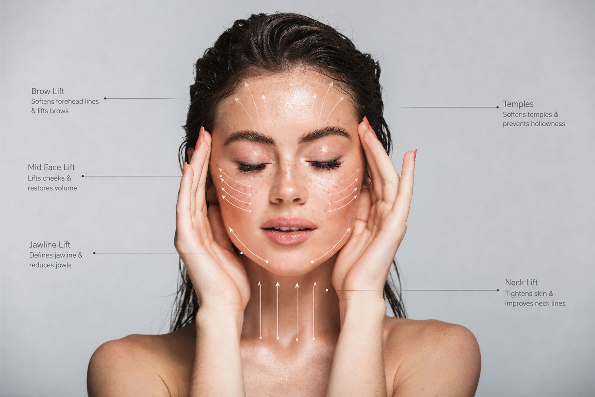 Woman with facial lift guide lines showing areas commonly treated with thread lift