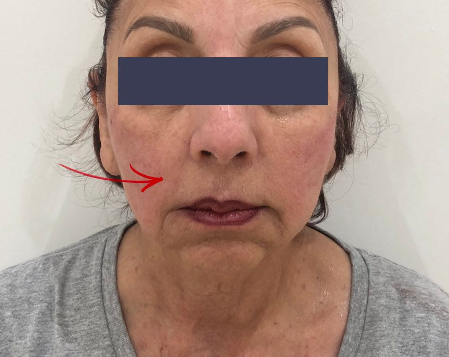 After photo showing improved facial contour following thread lift treatment