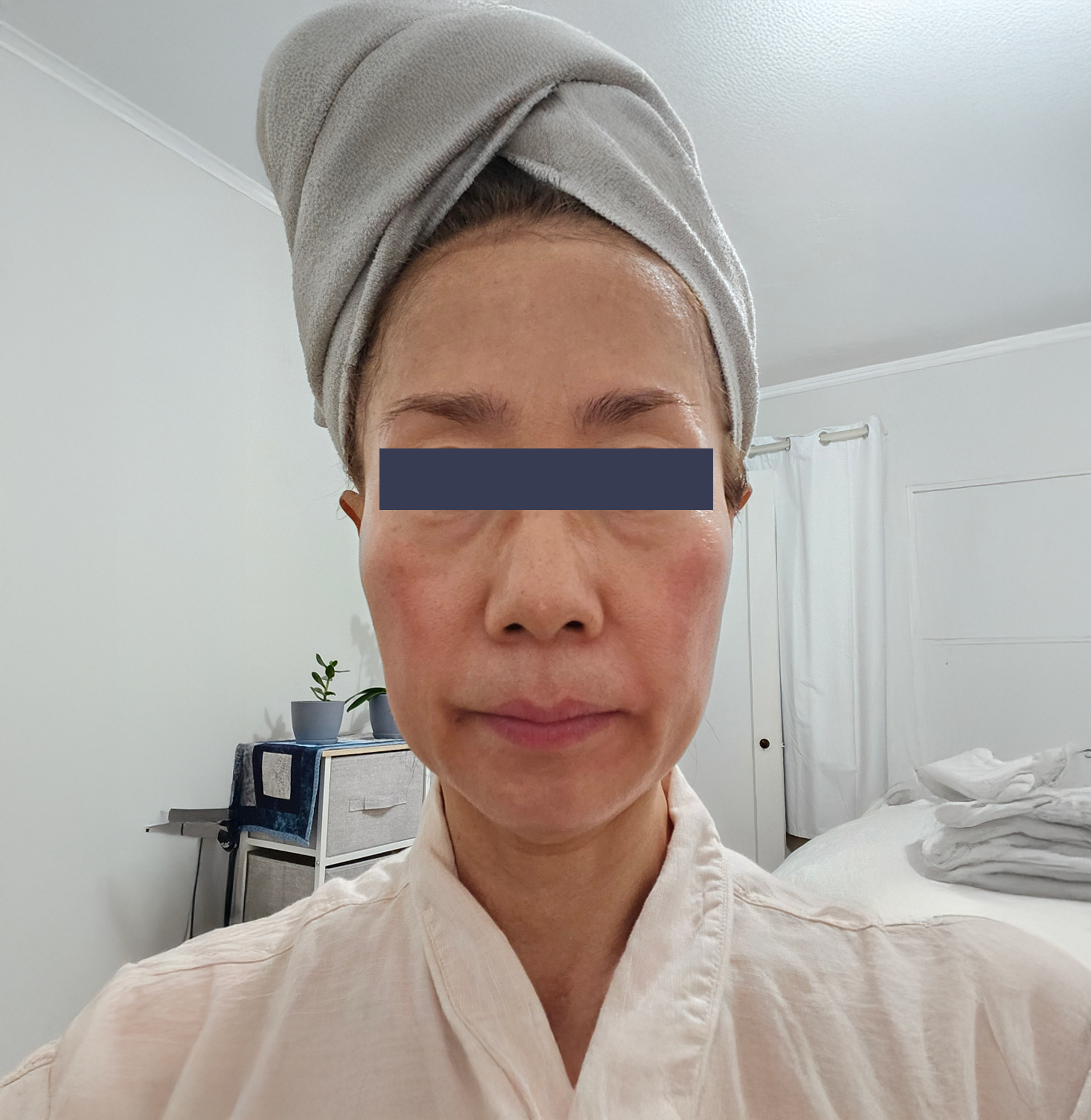 After photo showing smoother facial skin following Oligio skin tightening treatment