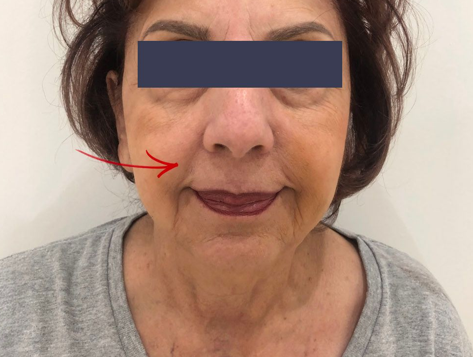 Before photo showing facial volume and contour prior to thread lift treatment