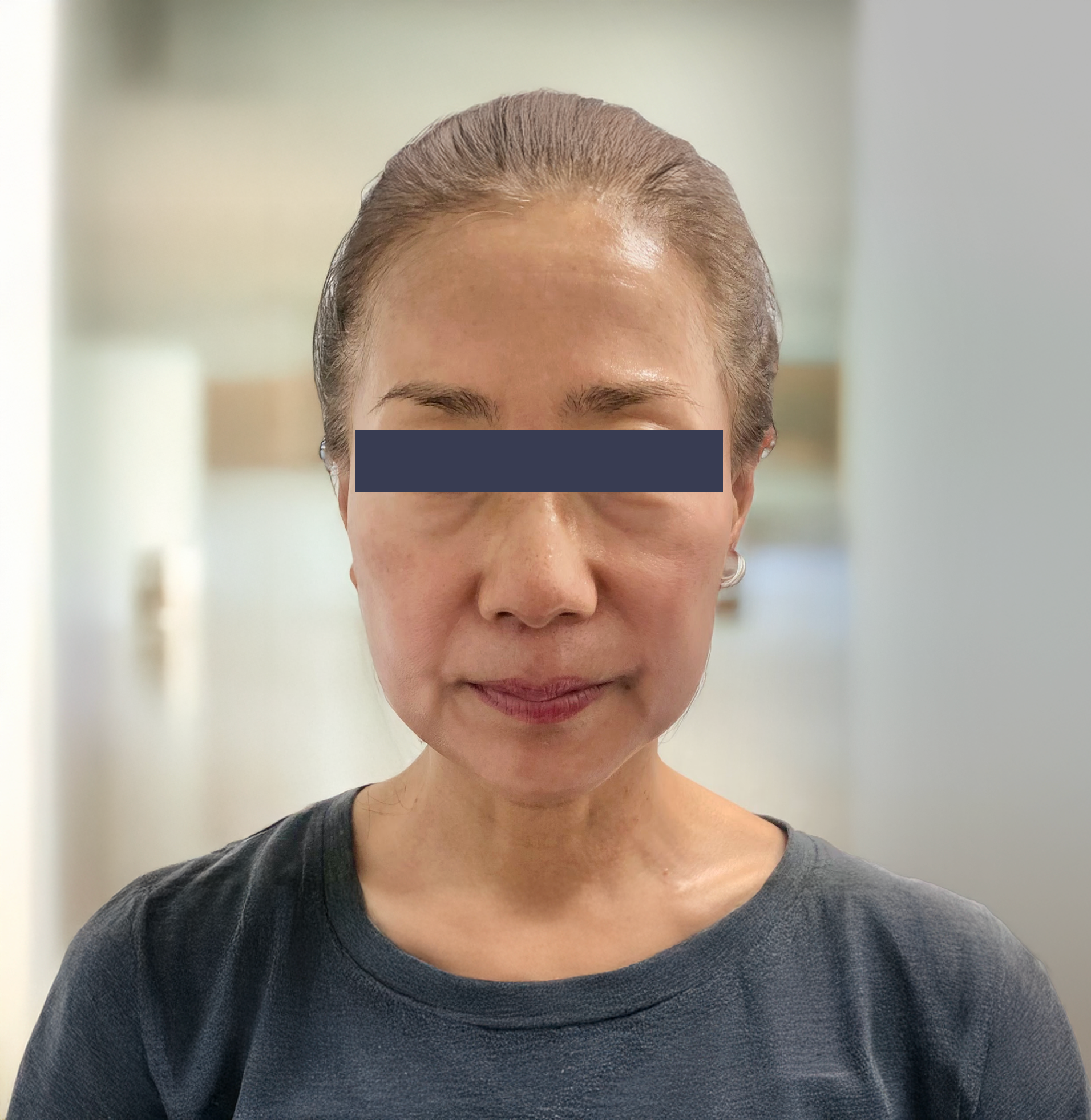 Before photo showing facial skin texture prior to Oligio skin tightening treatment
