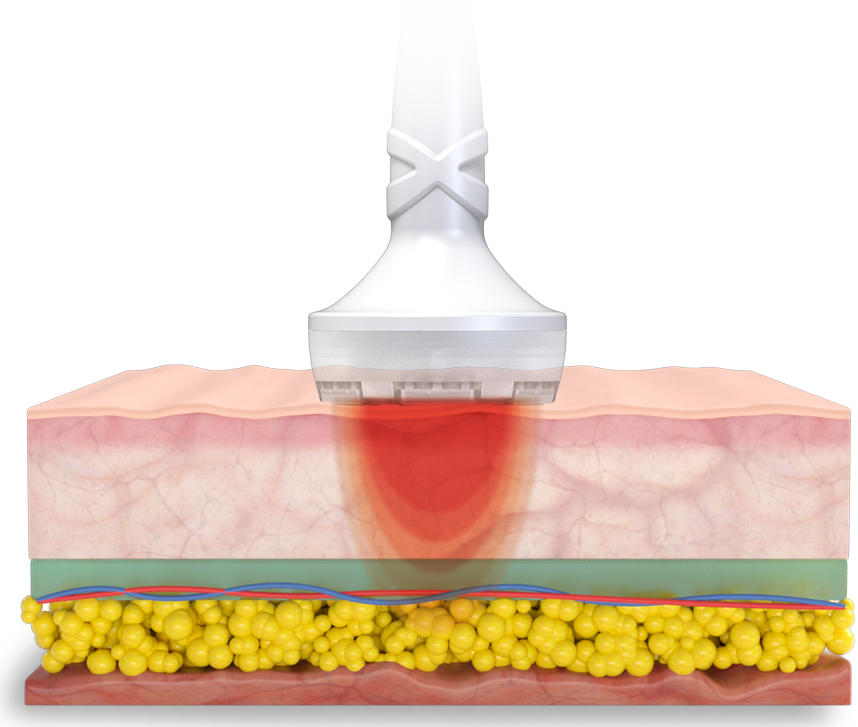 Graphic of RF energy on skin