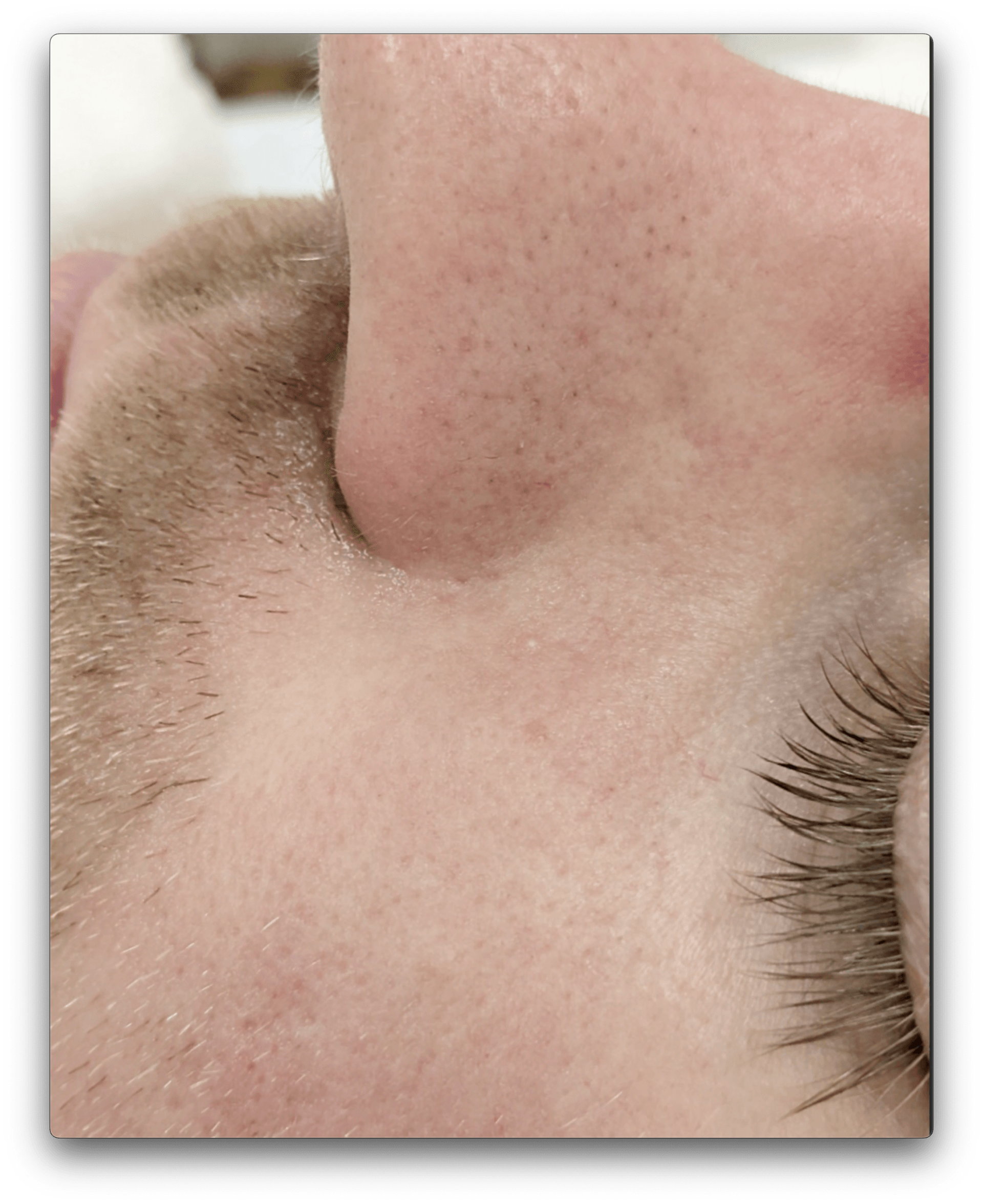 After treatment on nose