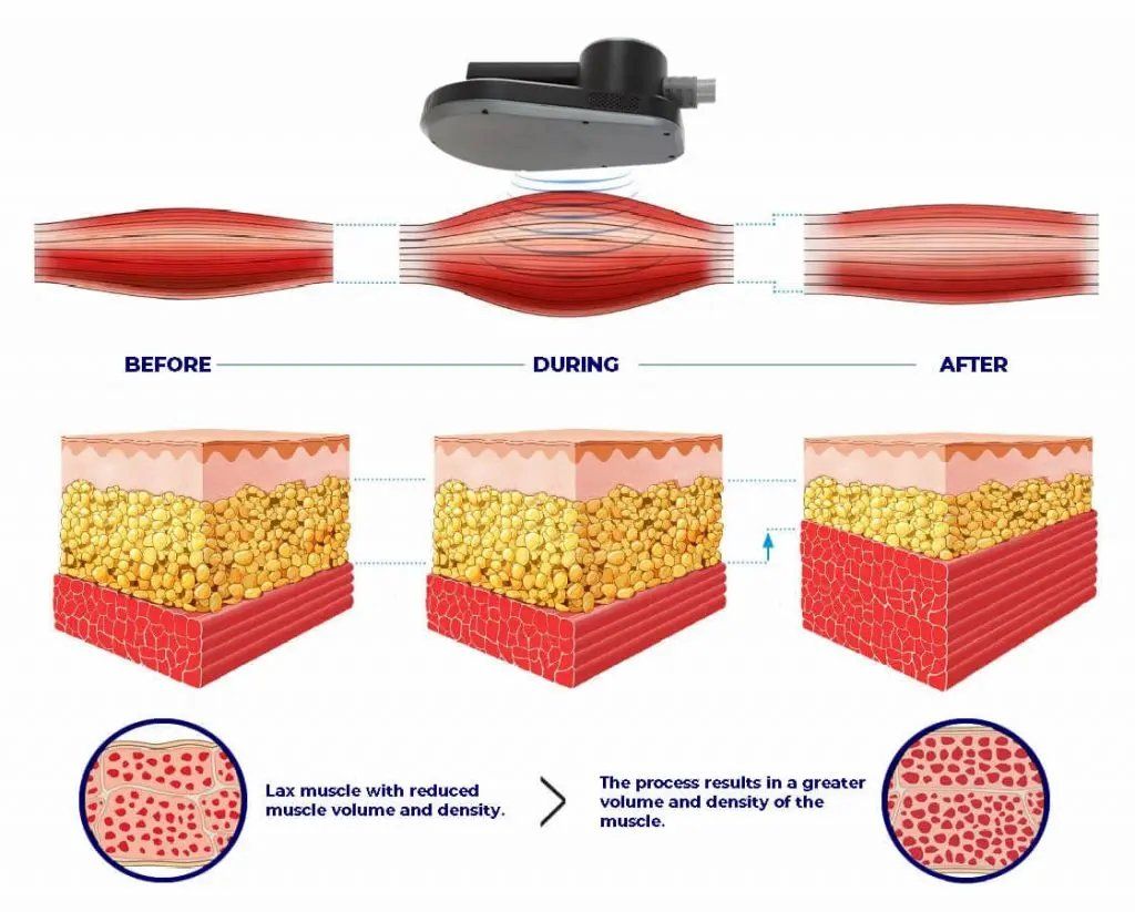 a diagram showing the process of lax muscle with reduced muscle volume and density