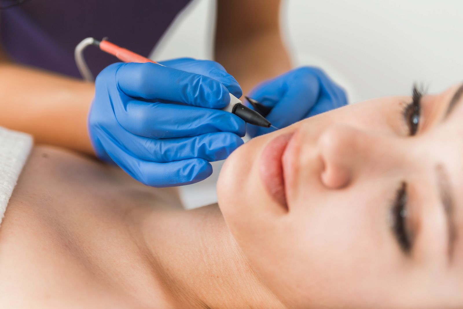 Electroepilation Treatment | Lake Geneva, WI | Bare Essentials Laser and Electrolysis Electroepilation Treatment | Lake Geneva, WI | Bare Essentials Laser and Electrolysis