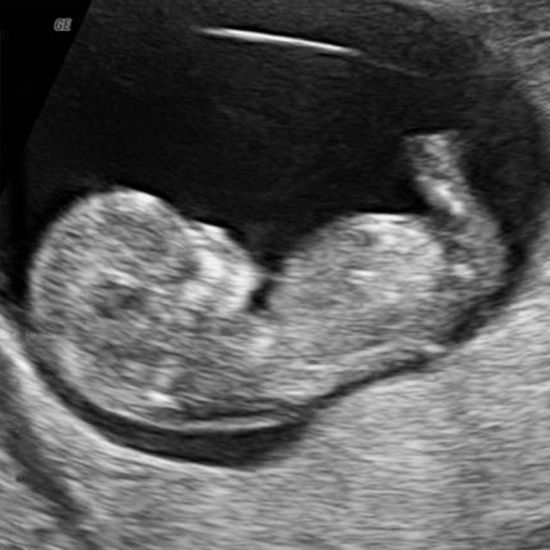 Ultrasound scan showing a curled fetus in the womb.