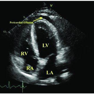 Echocardiogram showing labeled heart chambers and a pericardial effusion around the heart