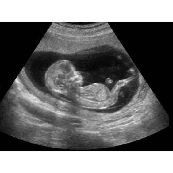 Ultrasound scan showing a fetus curled in profile inside the womb