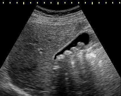 Ultrasound scan showing a fetus in the womb, dark fluid-filled area with bright tissue details