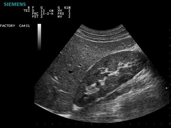 Grayscale abdominal ultrasound scan showing internal organs in a wedge-shaped view with machine overlay text
