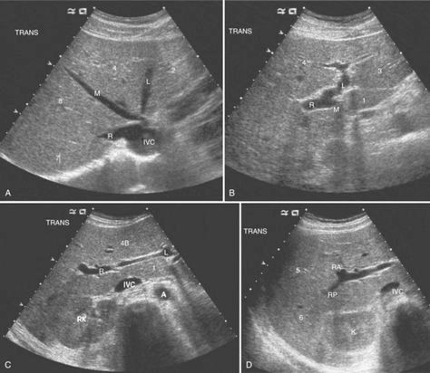 Four grayscale abdominal ultrasound panels showing labeled liver vessels and structures.