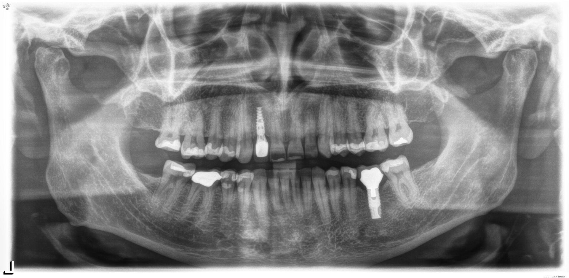 Dentist Checking the Teeth of a Female Patient — Minnetonka, MN — Cendar Hill Dental Center