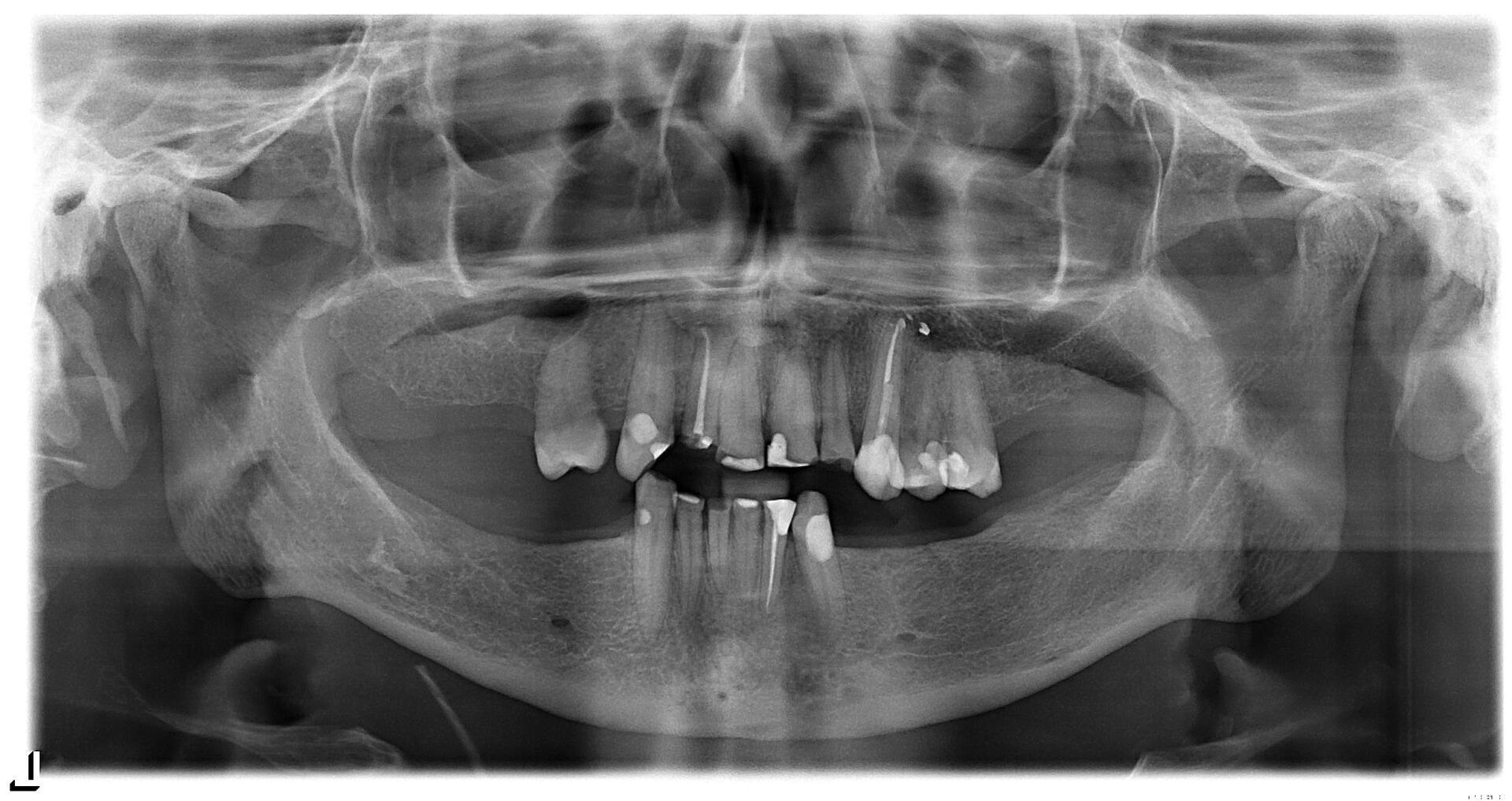 Dentist Showing Teeth Dentures to a Patient — Minnetonka, MN — Cendar Hill Dental Center Dentist Showing Teeth Dentures to a Patient — Minnetonka, MN — Cendar Hill Dental Center