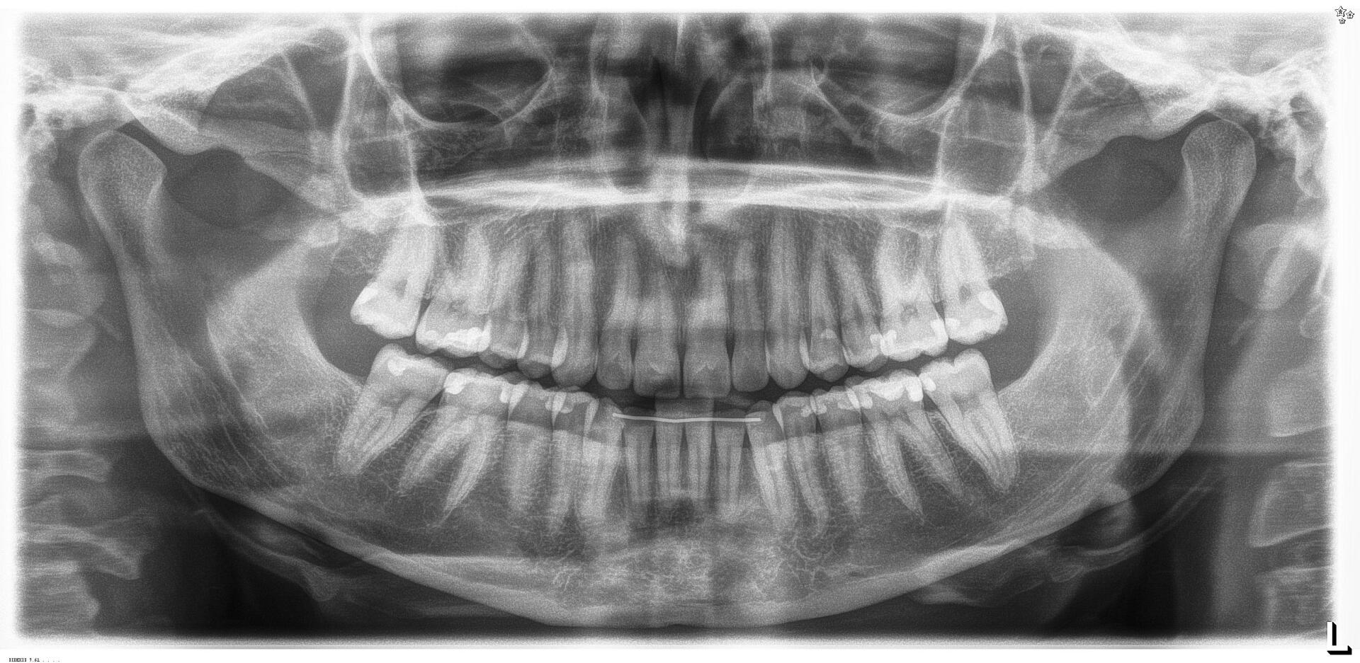 Woman Having Dental Work Done on Her Teeth — Minnetonka, MN — Cendar Hill Dental Center