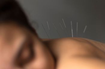 Primer plano de agujas de acupuntura insertadas en el hombro y la parte superior de la espalda.
