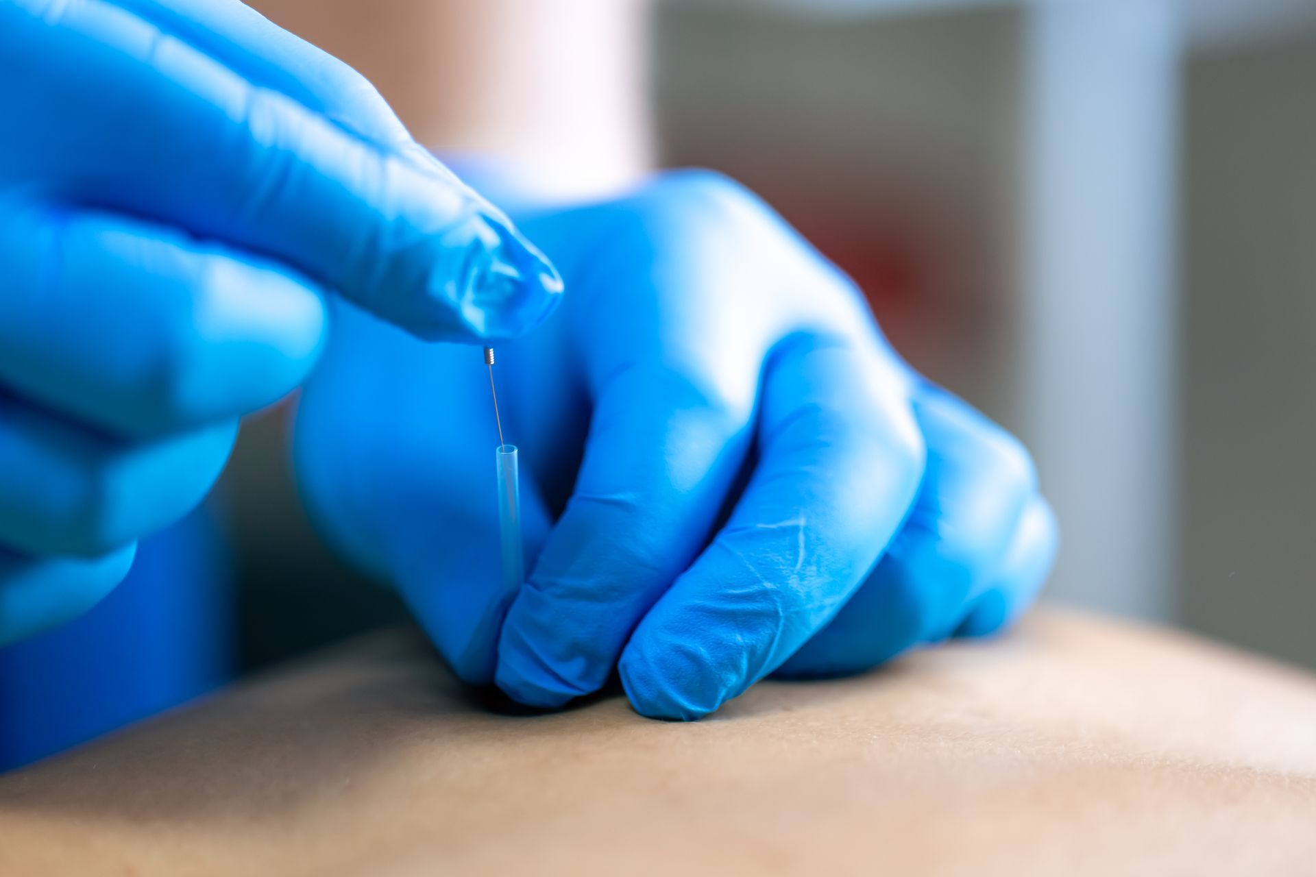 Primer plano de una mano enguantada que sostiene una aguja de acupuntura y la inserta en la piel.