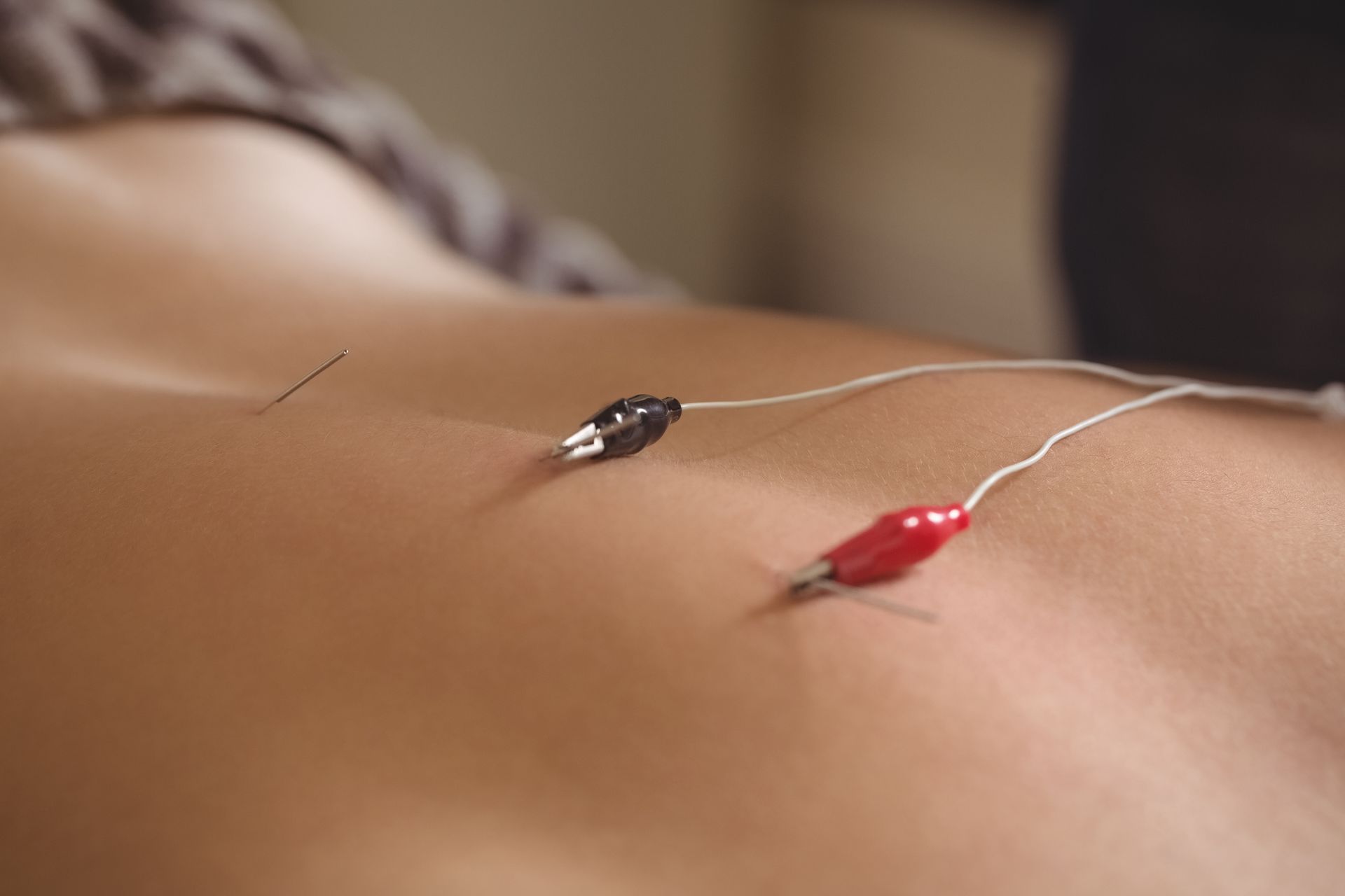 Primer plano de la espalda de una persona con dos agujas de acupuntura conectadas a cables eléctricos con pinzas rojas y negras.