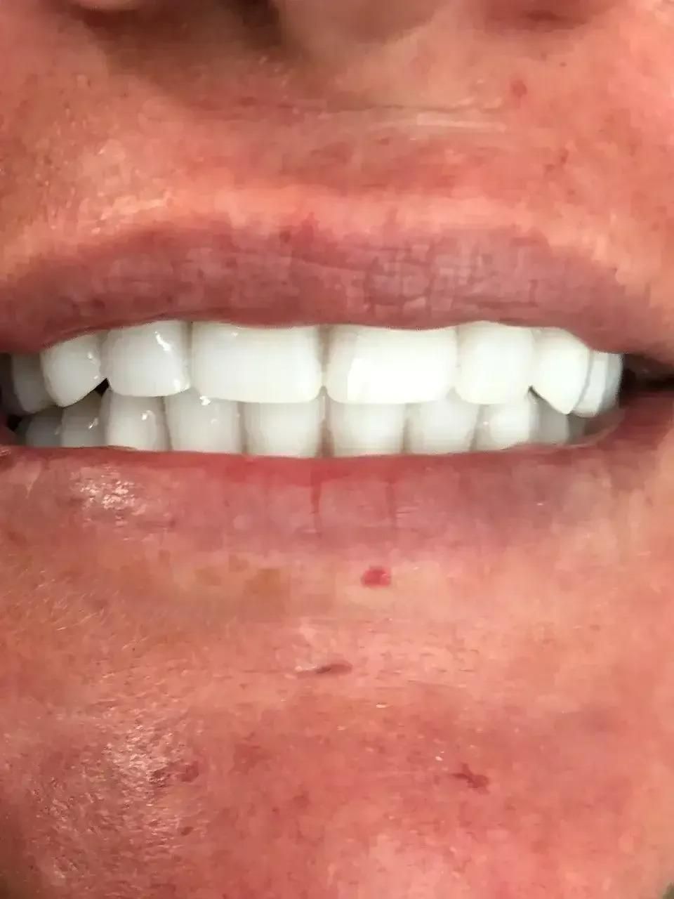 A Close Up of a Person's Mouth With White Teeth — Burleigh Heads Denture Clinic Gold Coast in Burleigh Heads, QLD