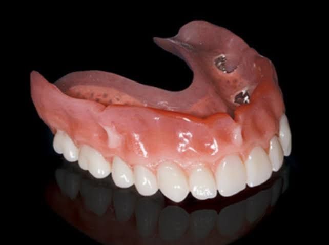 A person is holding a denture with screws on it. — Burleigh Heads Denture Clinic Gold Coast in Burleigh Heads, QLD