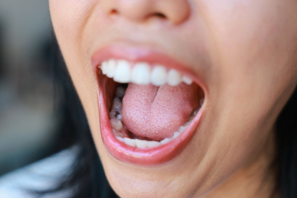 Close-up of tooth decay young woman, care, treatment— Burleigh Heads Denture Clinic Gold Coast in Burleigh Heads, QLD