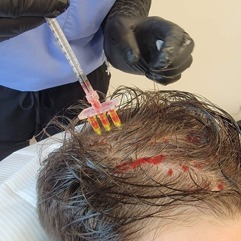 prf injection service
