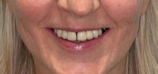 A close up of a person 's teeth with a missing tooth.