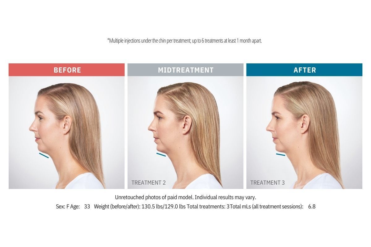 Kybella Before and After