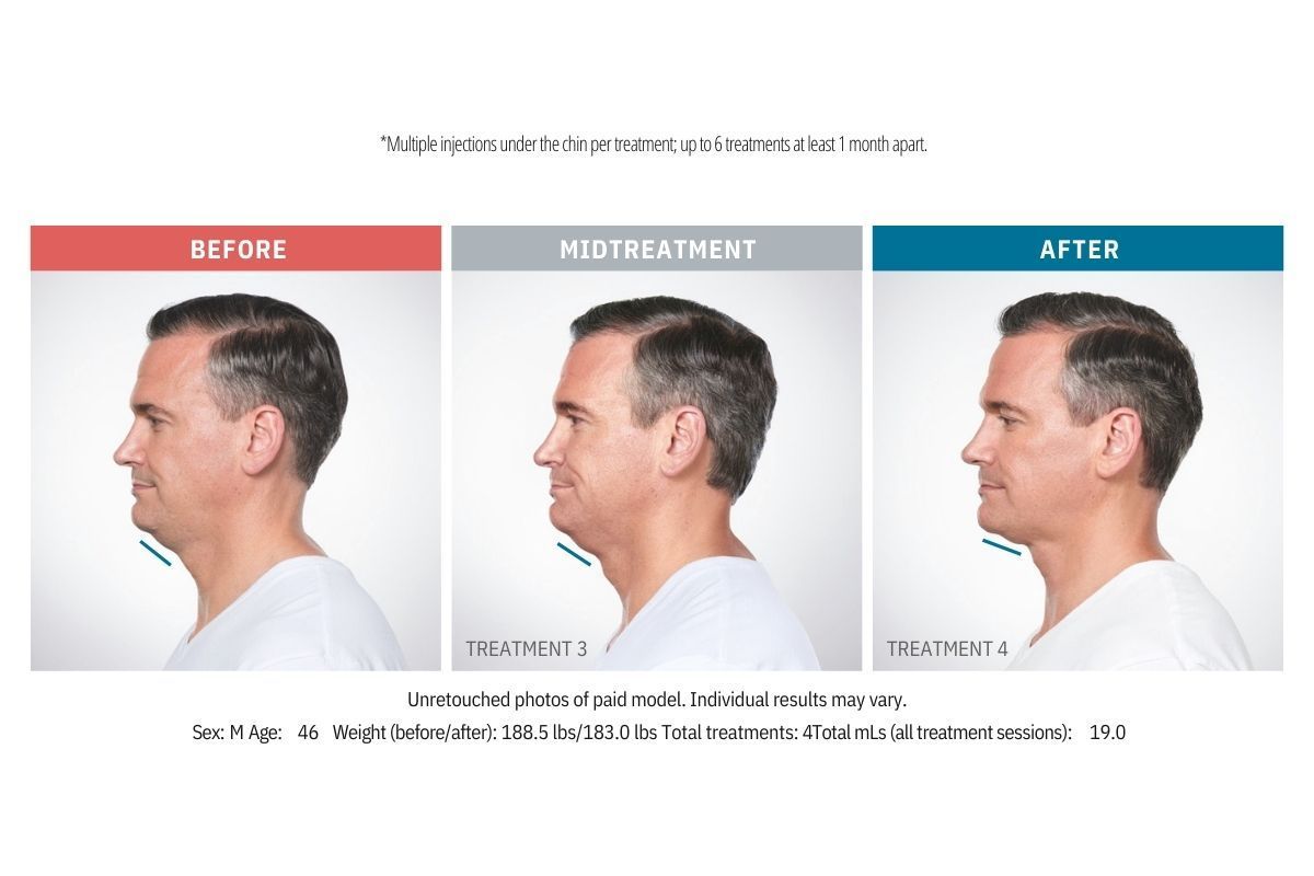 Kybella Before and After