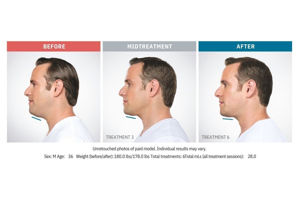 Kybella Before and After