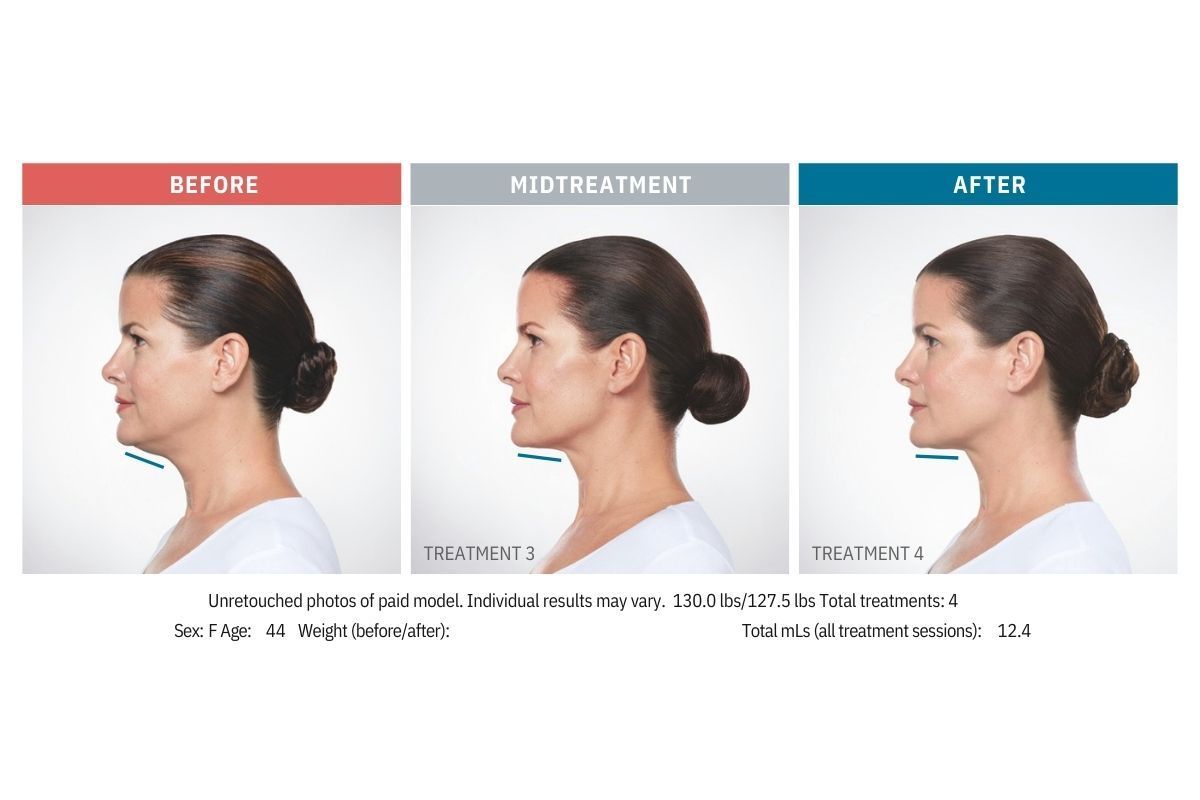 Kybella Before and After