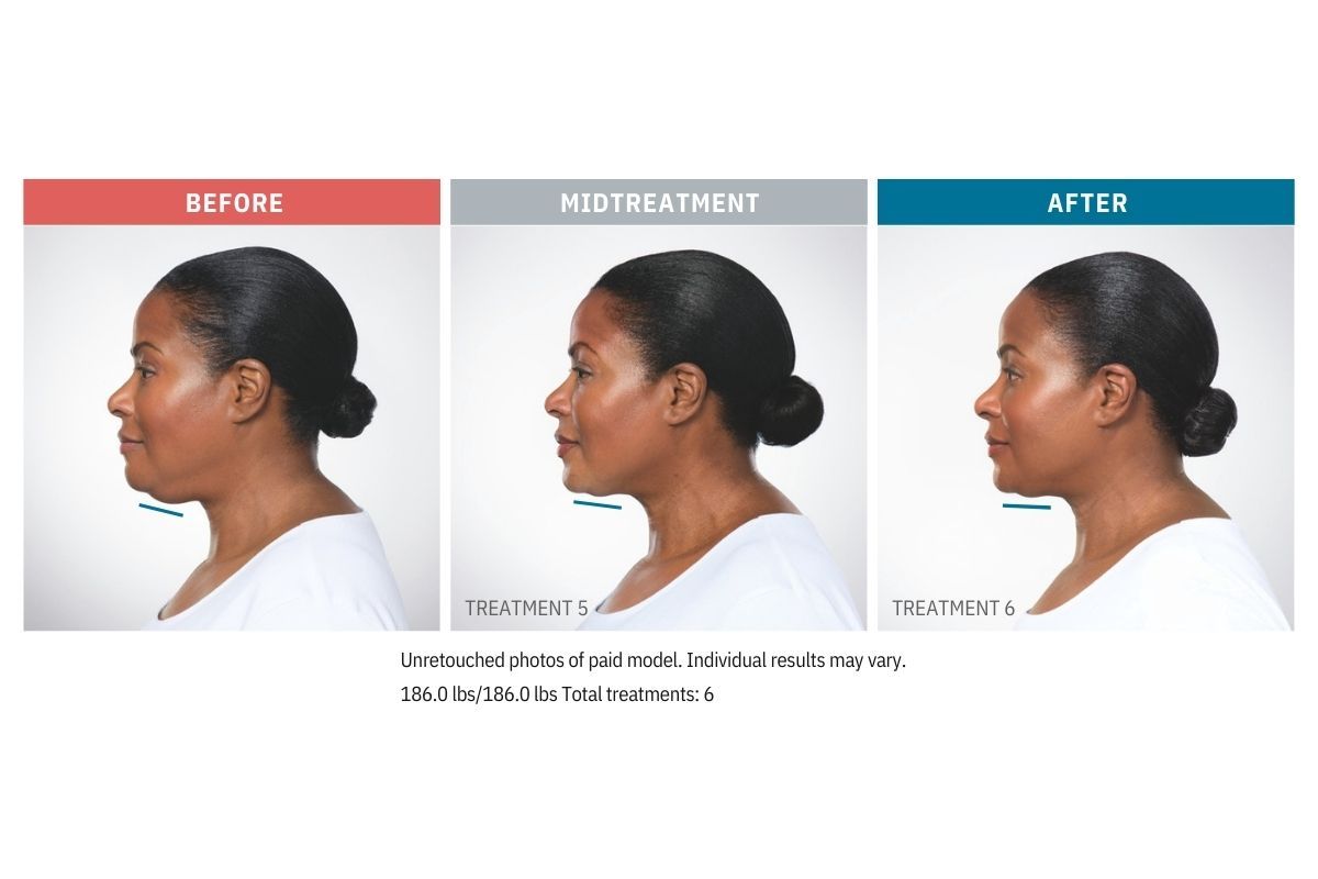 Kybella Before and After